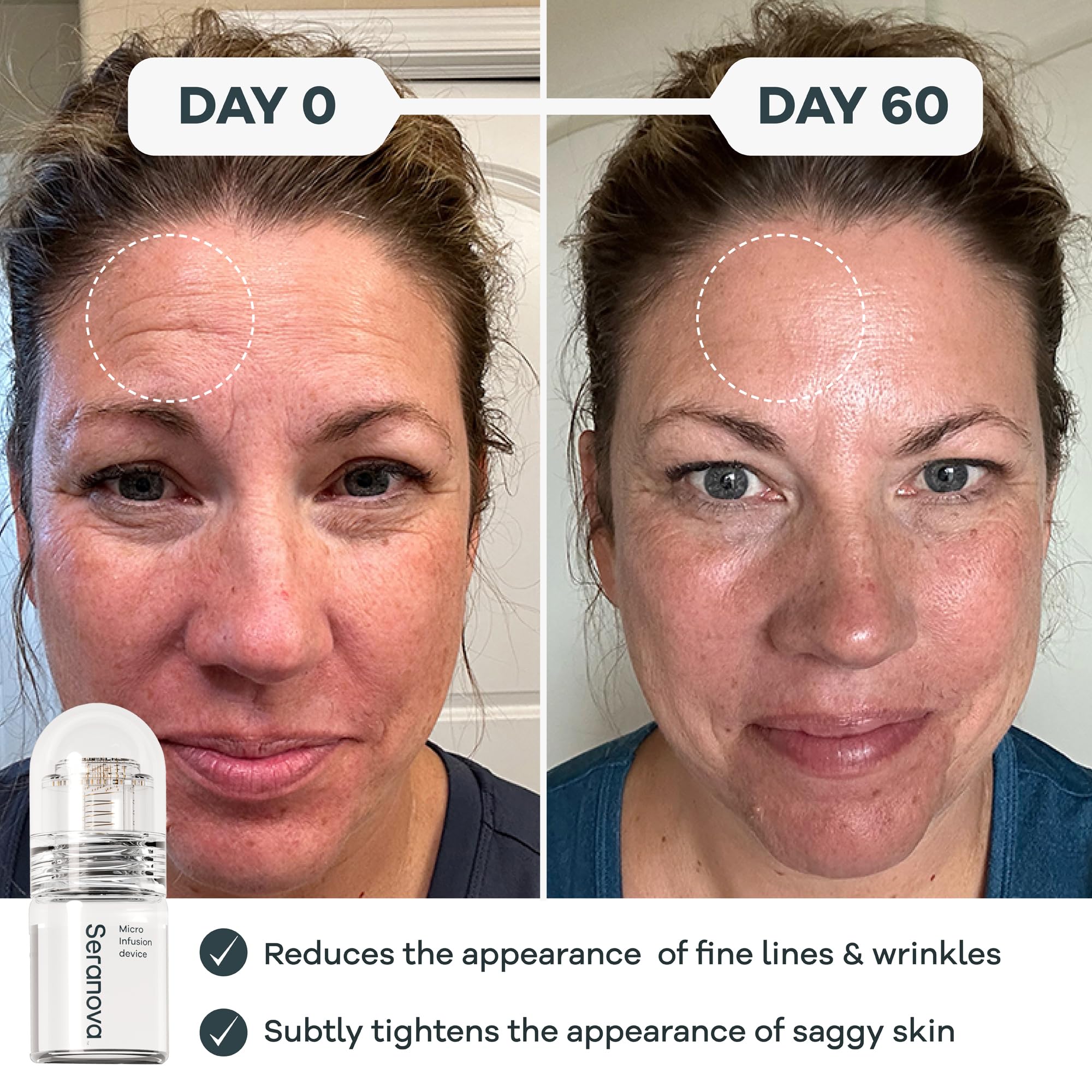 Seranova - Micro Infusion for Skin Care – with Collagen Peptides & Hyaluronic Acid, Face Serum and Stamp 0.05mm - 3 Month Supply