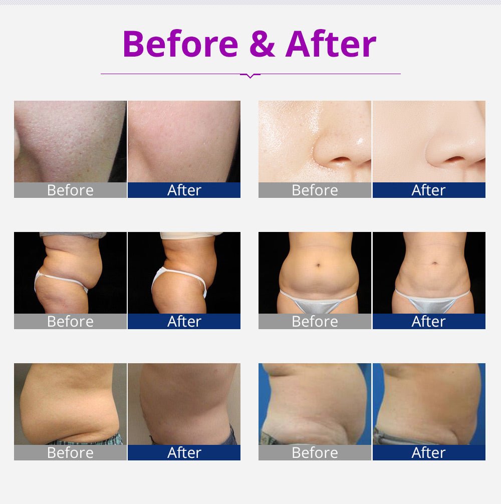 Kim 10 6-in-1 Cavitation RF Lipo Laser System