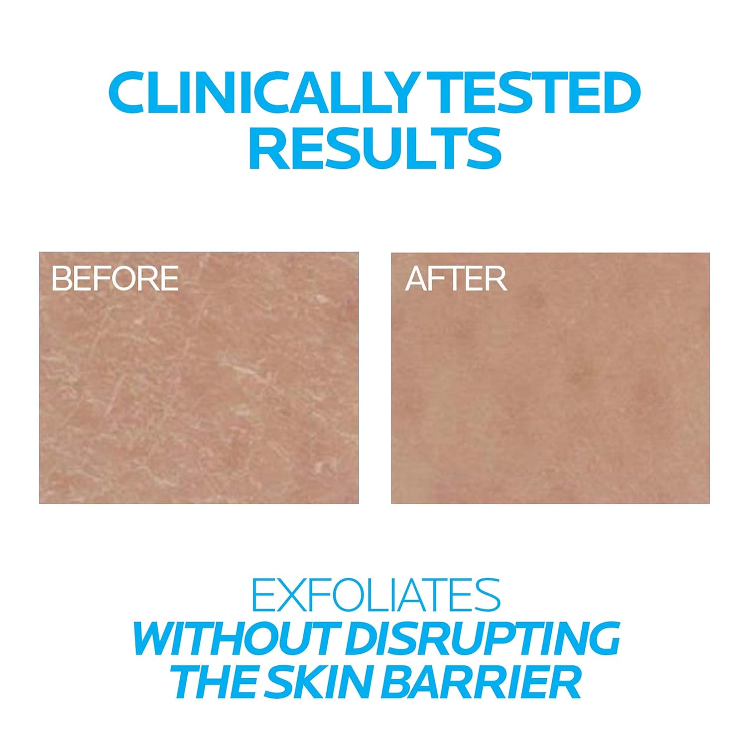 La Roche-Posay Lipikar Urea 10% Roughness Smoothing Lotion, Body Lotion For Dry Skin With 10% Urea + Shea Butter + Allantoin, Rough And Bumpy Skin Lotion, Softens & Smooths Skin With 1 Application