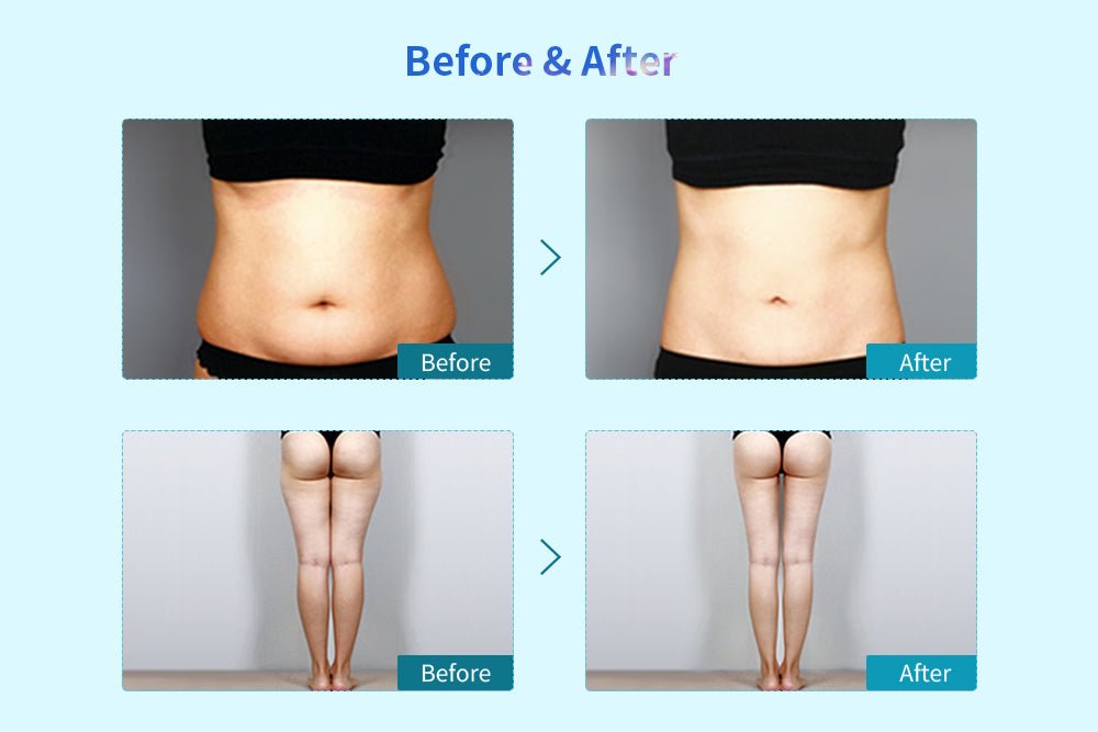 Shape Tactics Cryolipolysis Cold Vacuum Body Contouring System