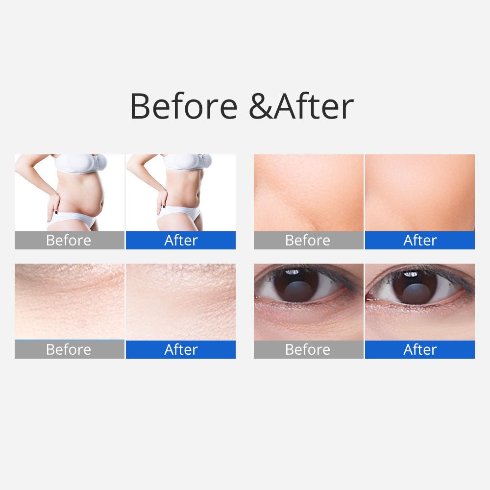 Shape Tactics 3-in-1 40K Ultrasonic Cavitation RF Slimming Machine