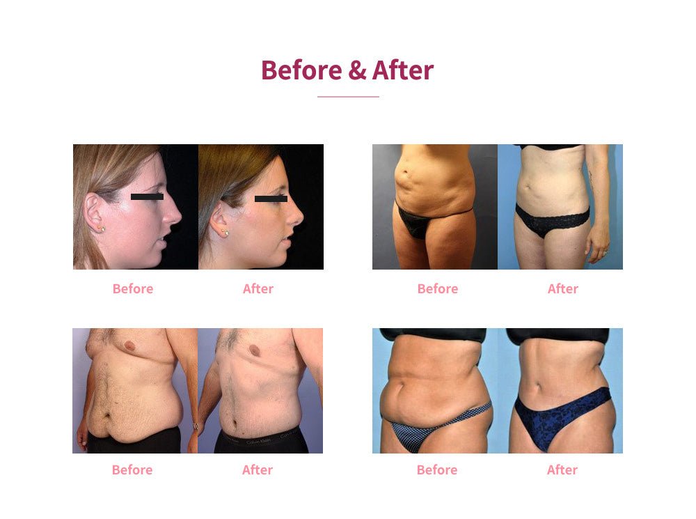 Shape Tactics 5-in-1 Cryolipolysis Vacuum RF Cooling System