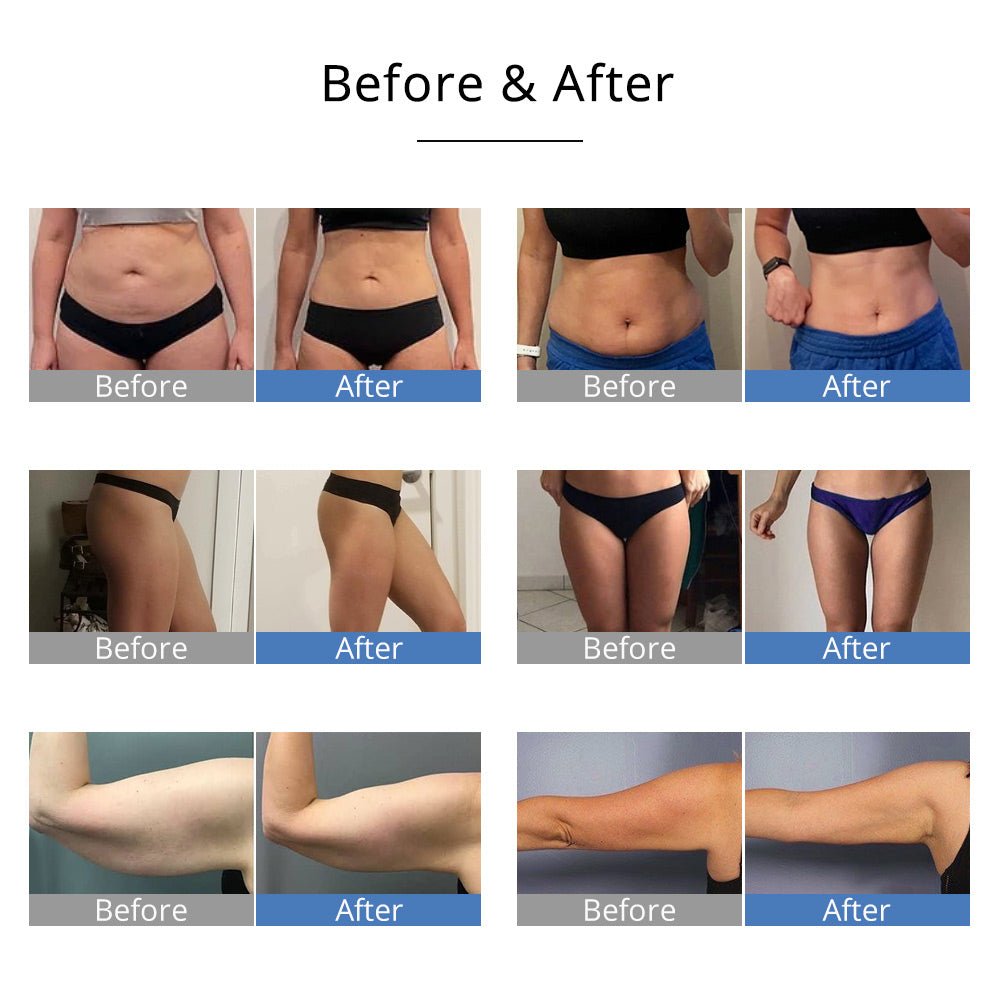 Shape Tactics 5-in-1 Ultrasonic Cavitation RF Vacuum System