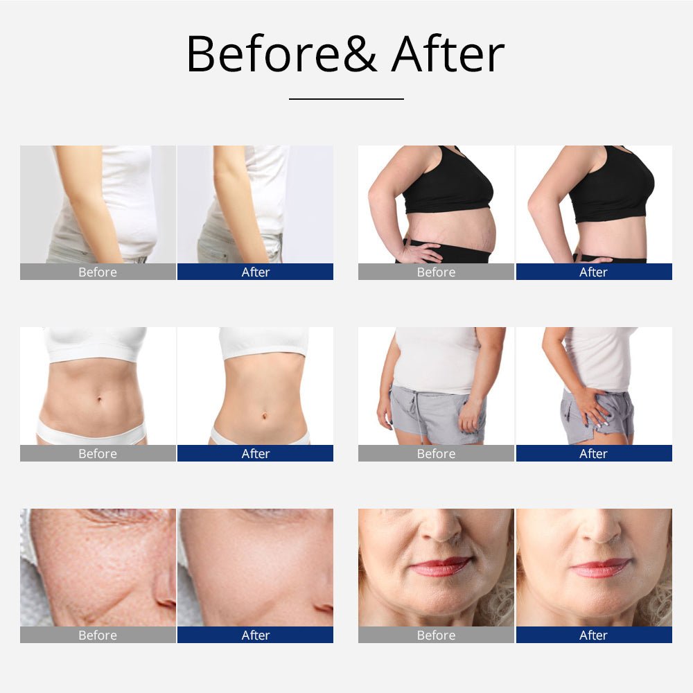 Shape Tactics 5-in-1 Unoisetion Cavitation 2.0 3D Smart Vacuum RF System