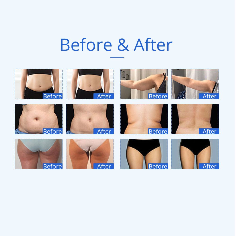 Shape Tactics 5-in-1 Unoisetion Ultrasonic RF Cavitation System