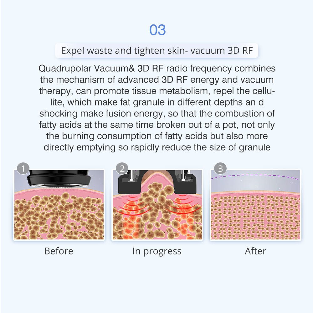 Shape Tactics 5-in-1 Unoisetion Ultrasonic RF Cavitation System