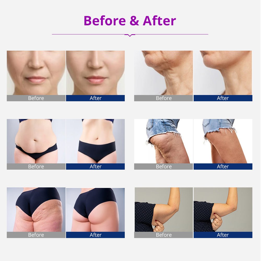Shape Tactics 5-in-1 Cavitation RF Vacuum Body Contouring System