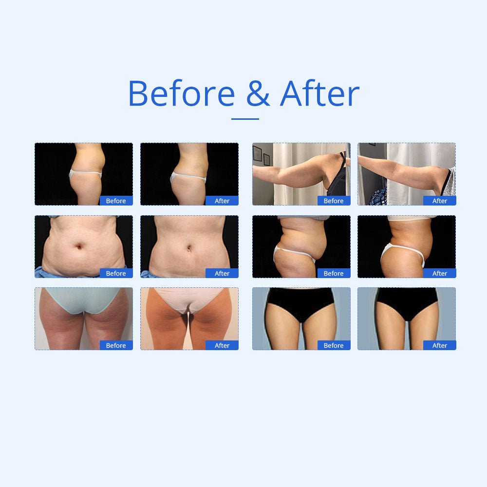 Shape Tactics 7-in-1 40K Ultrasonic Cavitation & RF Hot-Cold Therapy System