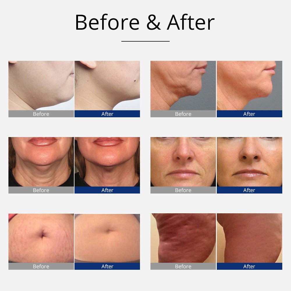 Shape Tactics 8-in-1 Cavitation RF Bio Hot and Cold Therapy System