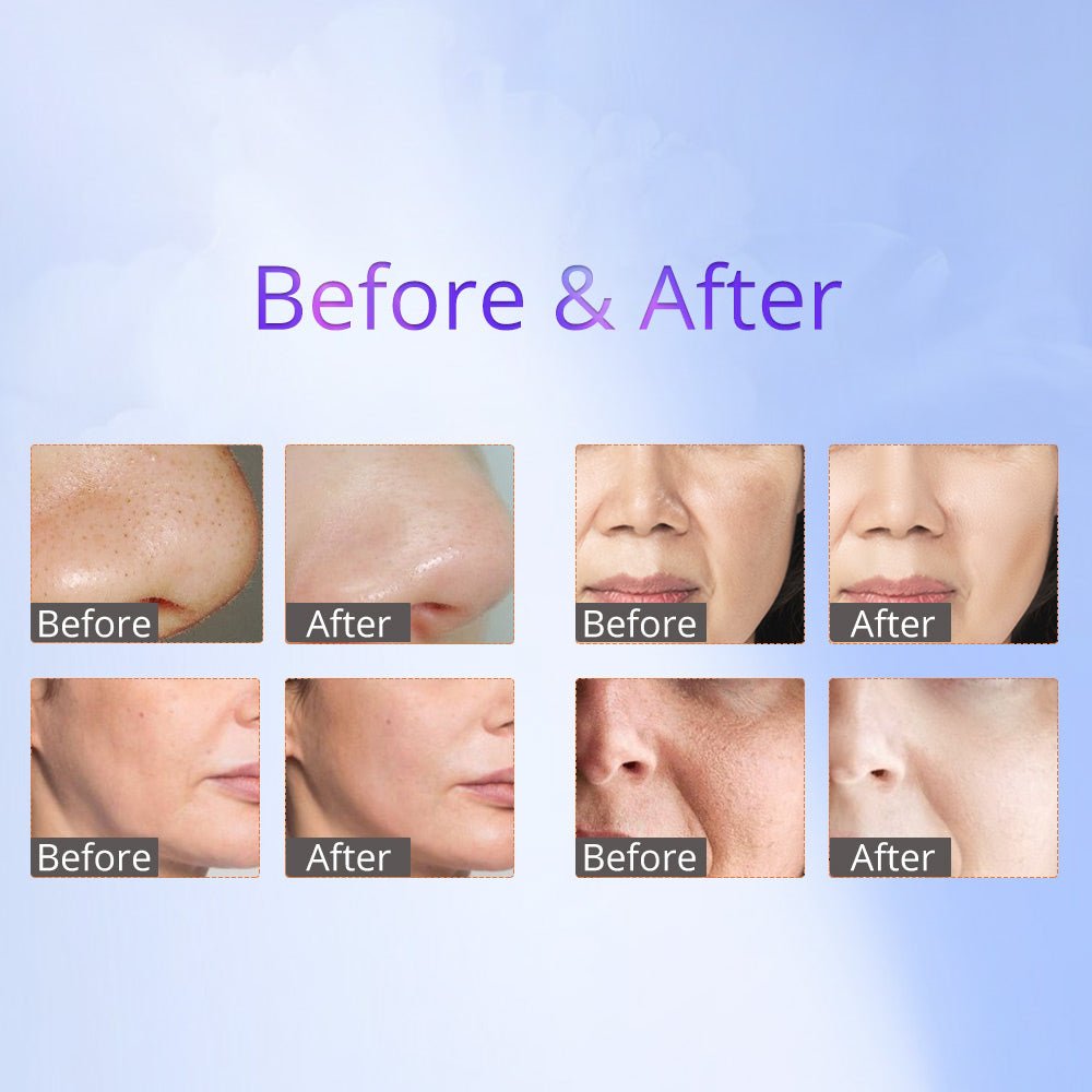 Shape Tactics 8-in-1 RF Skin Tightening System with Hot & Cold Hammer and BIO Therapy