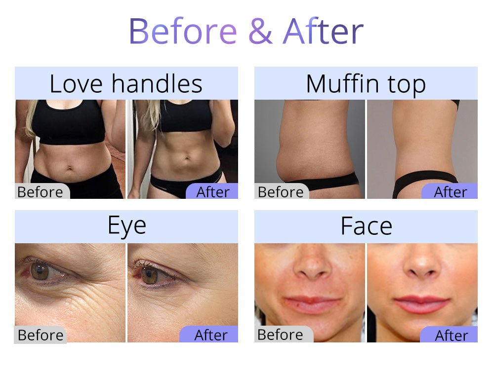 Shape Tactics 9-in-1 Smart RF 3D Cavitation System