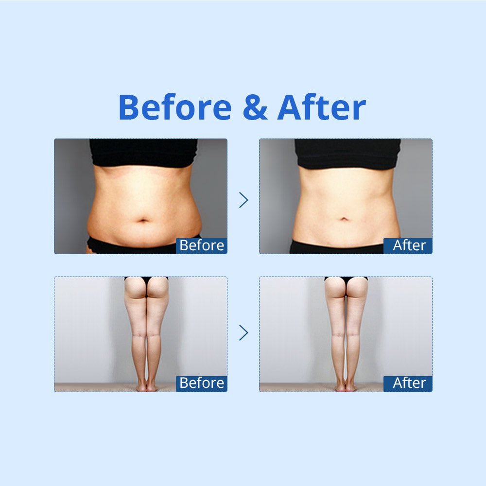 Shape Tactics Cryolipolysis Cold Vacuum Contouring System