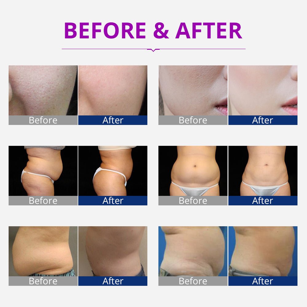 Shape Tactics Portable 5-in-1 Cavitation RF Vacuum Contouring System