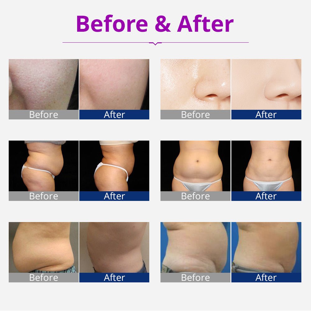 Shape Tactics Portable 6-in-1 Cavitation RF Vacuum Lipo Laser System