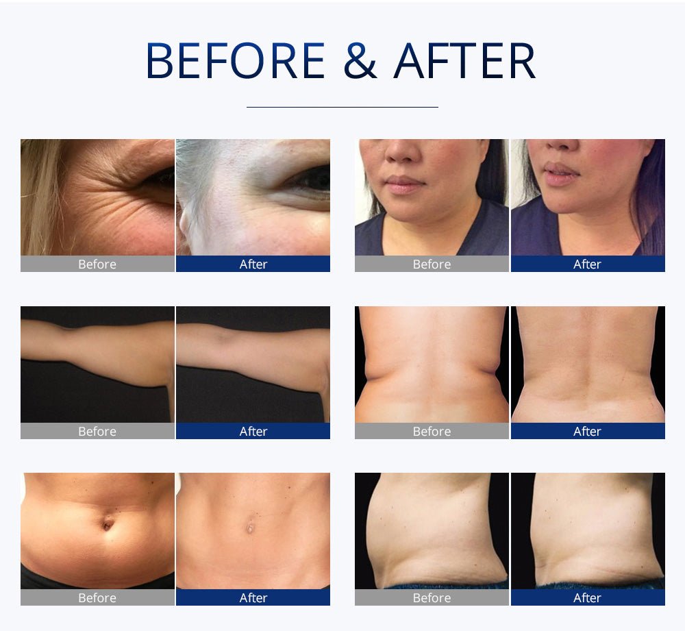 Shape Tactics S-Shape Pro 30K Cavitation RF Contouring System