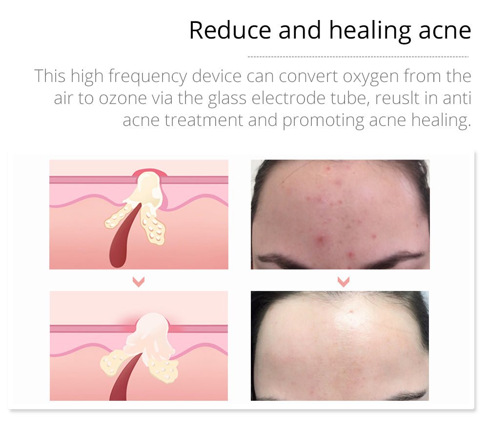 Shape Tactics Violet 7-Electrode High-Frequency Facial System