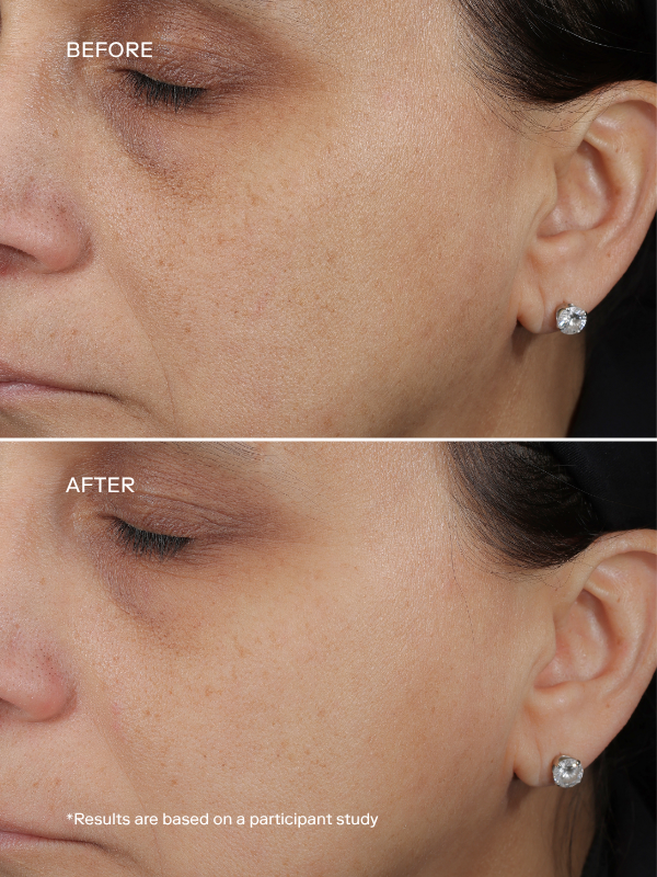 EXO H-SERUM™ Hyaluronic Acid Treatment