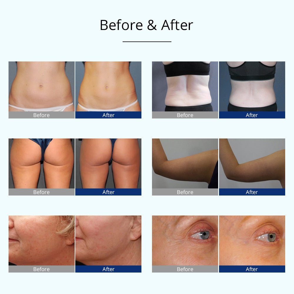 Shape Tactics 4-in-1 Cryolipolysis Cavitation RF Body Contouring System
