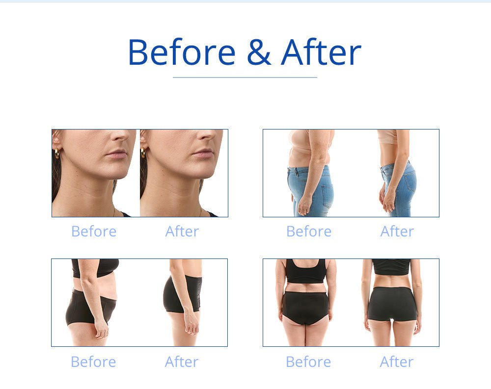 Shape Tactics 5-in-1 RF Cavitation Double-Handle Cryolipolysis Cooling System