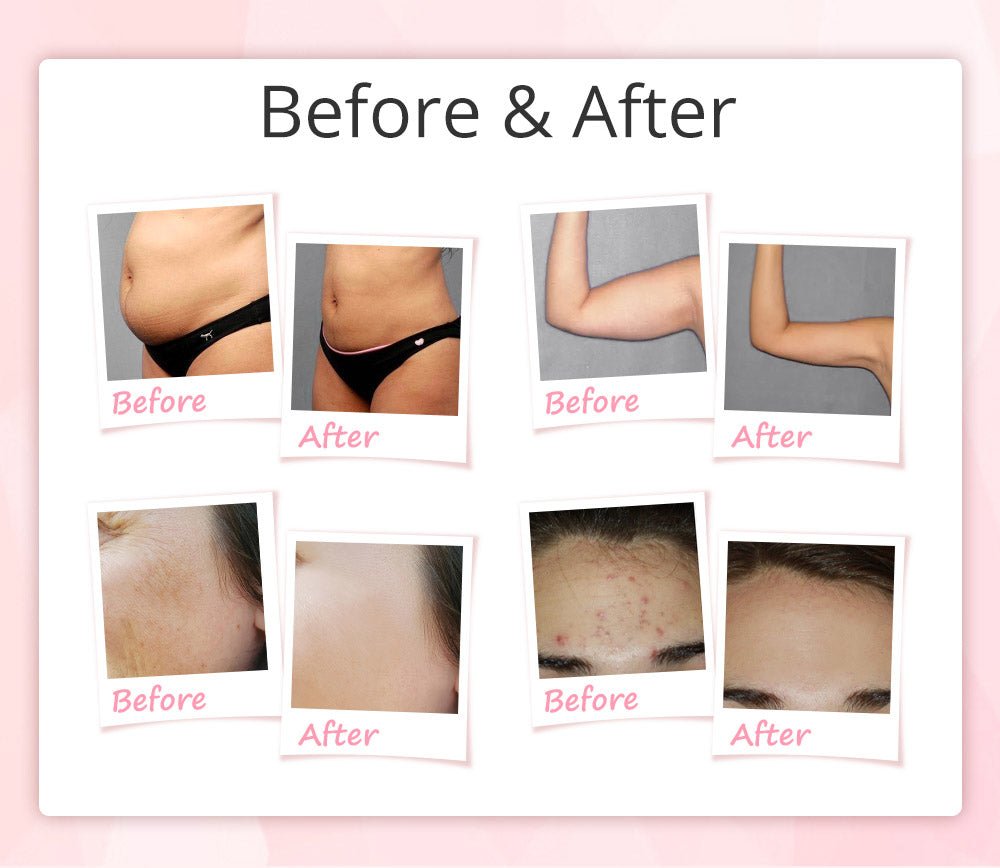 Shape Tactics 9-in-1 Unoisetion Cavitation RF Vacuum Bio Photon System