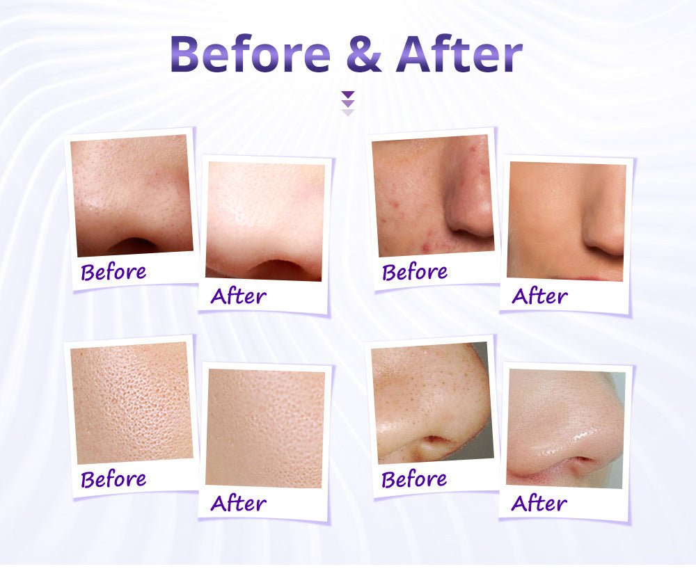 Shape Tactics Diamond Microdermabrasion & Hydrating Mist System