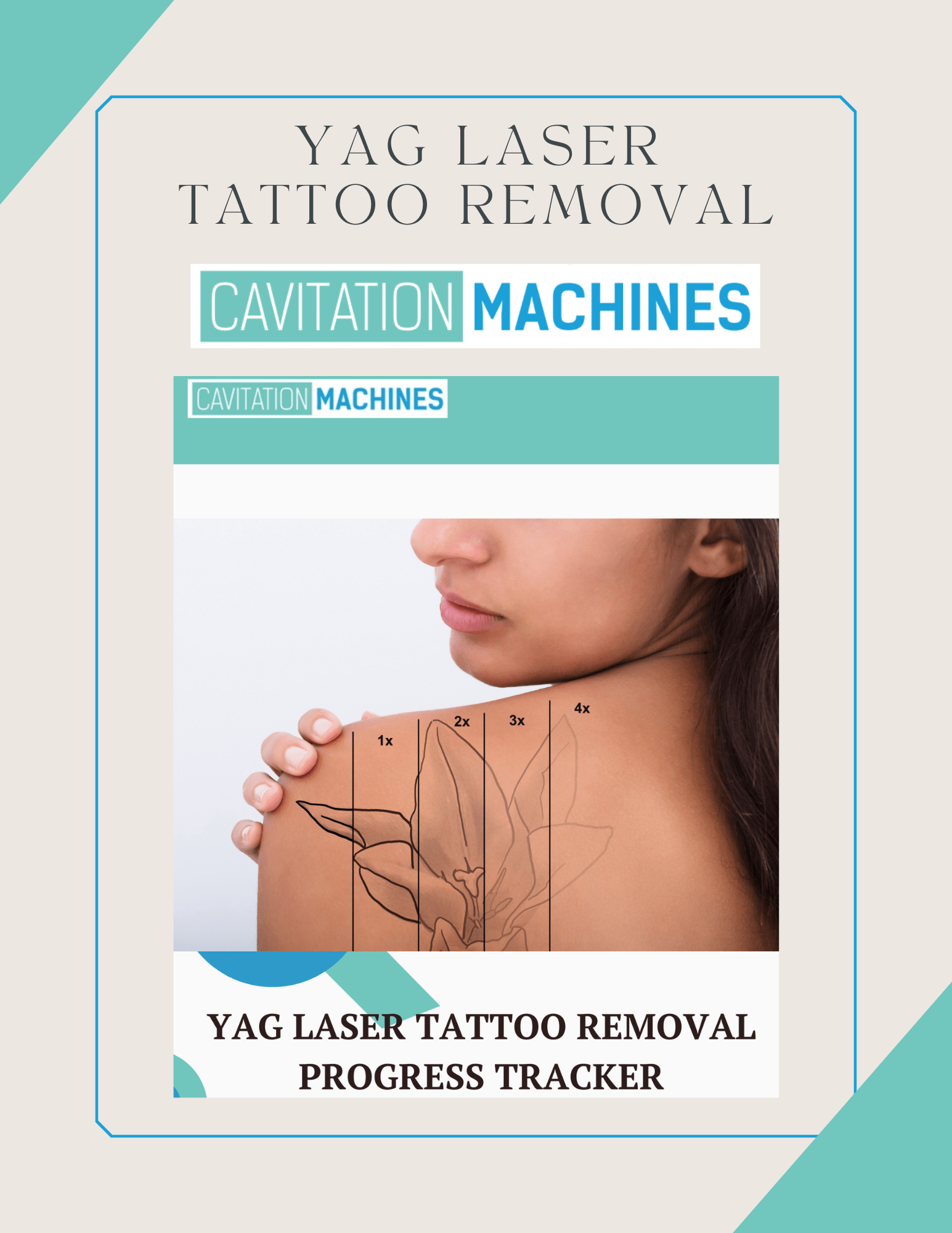 Shape Tactics YAG Laser Tattoo Removal Progress Tracker